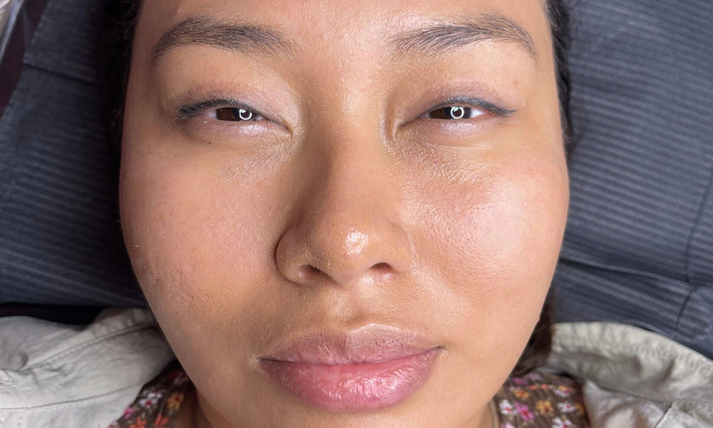 BB Glow Treatment: What It Is and How It Benefits Your Skin