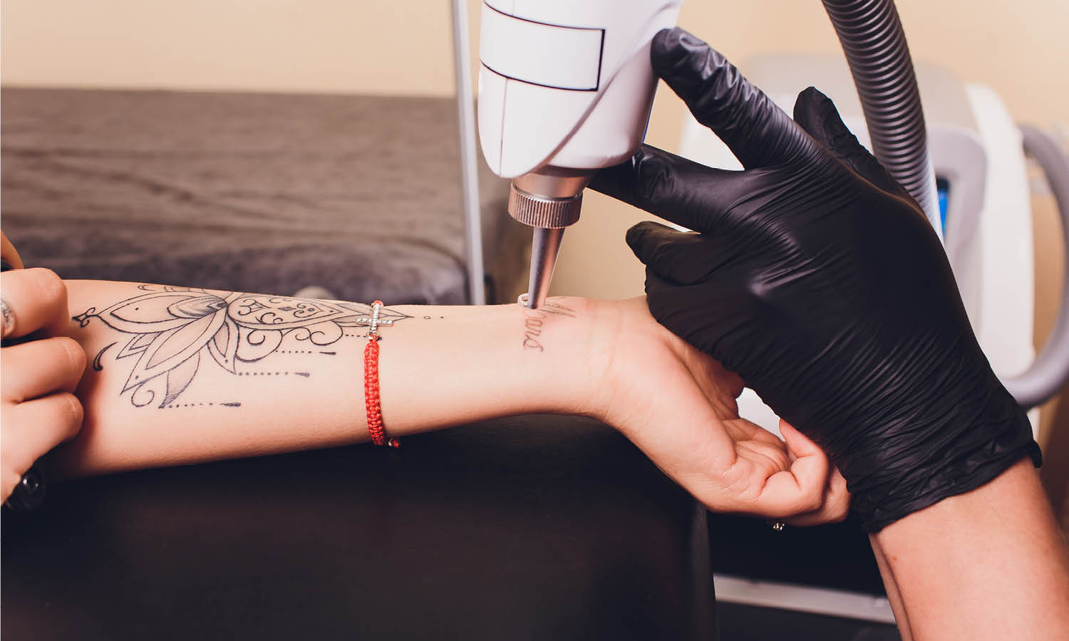 Tattoo Removal: Procedure Insights & Information