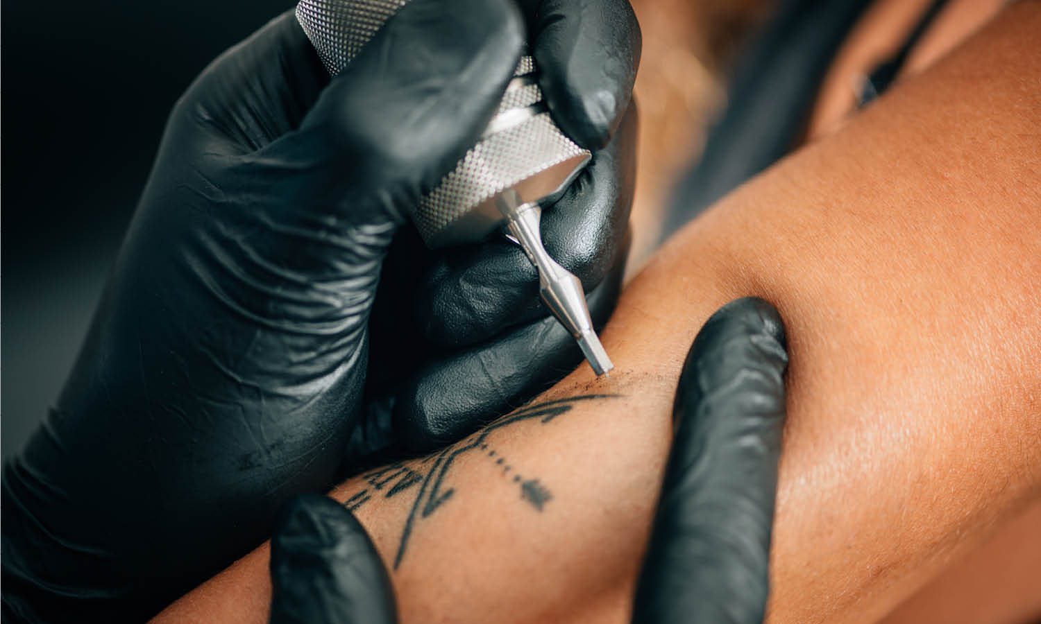 How Painful Is Tattoo Removal?