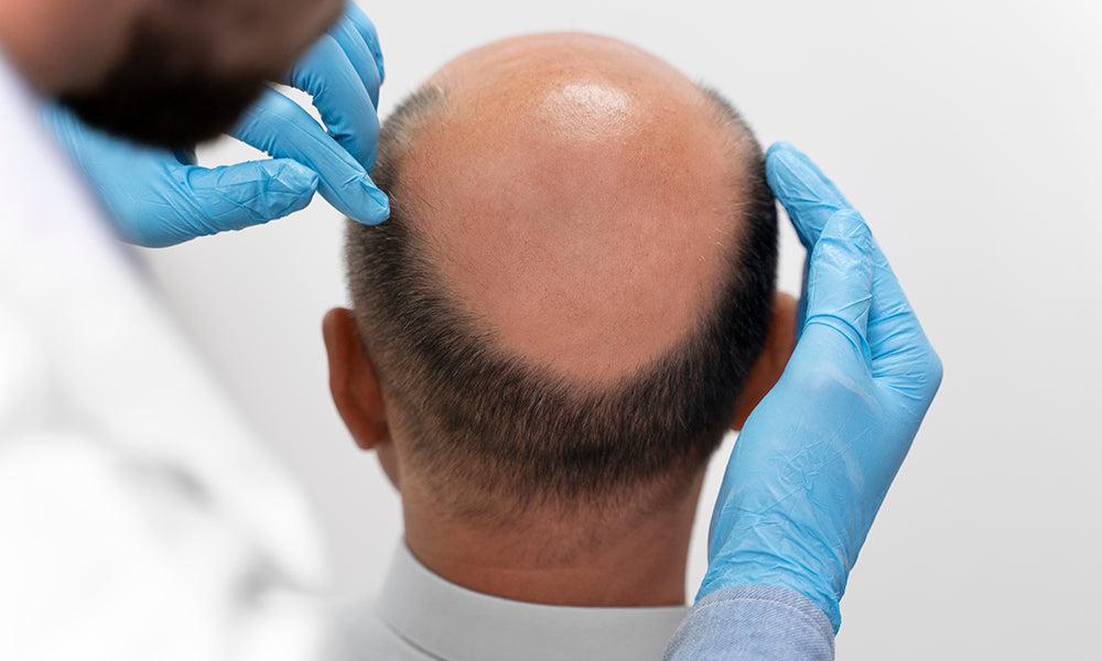 Recovery Timeline After a Hair Transplant: What to Expect